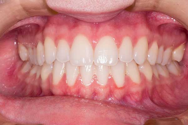 dentes brancos